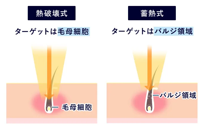 ヒゲの医療脱毛の二つの脱毛方式