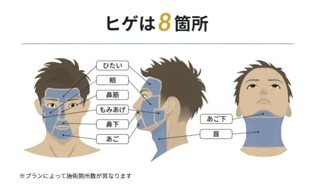 レジーナクリニックオムの脱毛部位